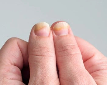 To tomler med gule negler, nærbilde som viser symptomer